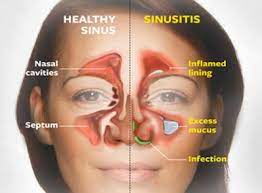 Top Natural Remedies For Sinus Congestion You Can Make At Home Positivemed Sinus Infection Remedies Home Remedies For Sinus Natural Treatments