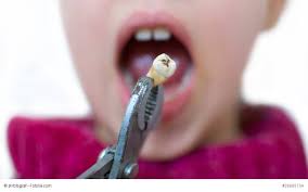 Muss ein zahn gezogen werden, gehen dieser therapie häufig. Zahn Raus Und Nun Tipps Fur Die Zeit Danach
