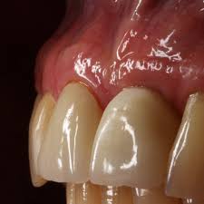 Cemental tears have been rarely reported in the endodontic literature. Interesting Case Of A Cemental Perioimplantsmichigan Facebook