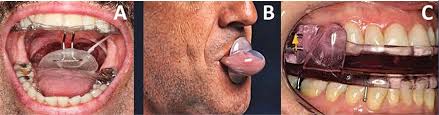 Maybe you would like to learn more about one of these? Dispositivos Orales Para El Tratamiento Del Apnea Obstructiva Del Sueno Atm Disorders
