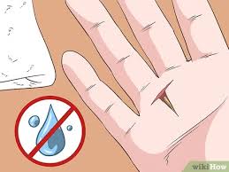 Einen Tiefsitzenden Splitter Entfernen Wikihow