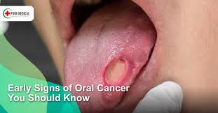 Image result for cancer tongue symptoms)