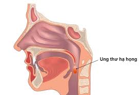 Đầu năm nay, nghệ sĩ giang còi phát hiện bị ung thư hạ họng giai đoạn 3 và đã di căn. Tim Hiá»ƒu CÄƒn Bá»‡nh Ung ThÆ° Háº¡ Há»ng Ma Nghá»‡ SÄ© Giang Coi Phat Hiá»‡n Khi Ä'a Di CÄƒn Vietnamnet