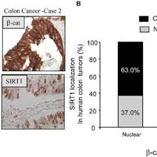 Feline lymphoma most commonly affects the intestines. Sirt1 Expression Occurs In A Subset Of Human Colon Cancers And Download Scientific Diagram