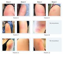 'covid arm' rash seen after moderna vaccine annoying but harmless, doctors say. Skin Reactions To Pfizer Moderna Covid 19 Vaccines No Cause For Alarm Experts Say Health24