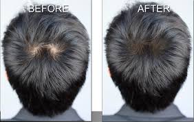 Gallery Hair Loss Solution Scalp Shading Microart Semi Permanent Makeup Hair Loss Solutions Hair Loss Men Permanent Makeup