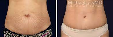 Belly Button Before After Photos
