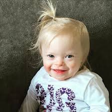 Down syndrome — Save Down Syndrome