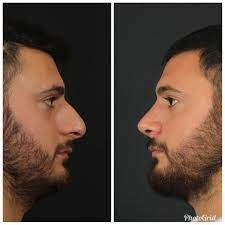 5 Months After Rhinoplasty Basarili Bir Burun Ameliyatinda Burunda Cokme Ve Ucunda Dusme Olmayacaktir 5 Ay Ko Instagram Nose Fictional Characters