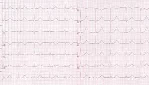 Langes Qt Syndrom