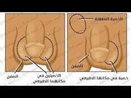 الخصية المعلقة عند الأطفال خطير جدا Youtube