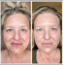 Is there a way to feel good about your skin again?