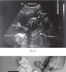 Club foot may affect one or both feet. Pdf Prenatal Ultrasound Diagnosis Of Club Foot Outcome And Recommendations For Counselling And Follow Up Semantic Scholar