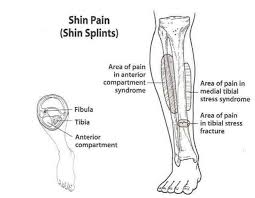 In fact, some studies have reported shin splints to occur in nearly twenty. Injury Tips Shin Pain Or Goat Run Trail Running Series Facebook
