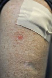 But that doesn't mean you shouldn't carefully weigh all of your options i had biopsies of a flat beige spot on my cheek and a scaly shin colored spot on my nose. Surviving With Skin Cancer A Way Of Life Air Combat Command Display