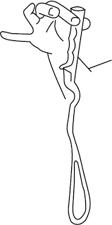 Kielland's forceps was the most popular method for rota­ tional delivery, with the senior specialists preferring it while junior specialists tended to use the ventouse (p<o.o i) (table iii). Instrumentalvaginal Delivery Chapter 14 Obstetric And Intrapartum Emergencies