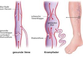 Krampfadern Gesundheitsinformation De