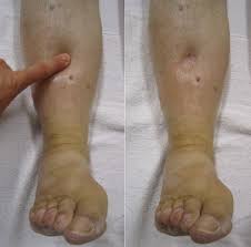 Deep Vein Thrombosis Physiopedia