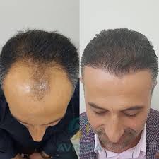 However, permanent hair loss can not be stopped this way. Pin Auf Hair Transplant Before And After Cases
