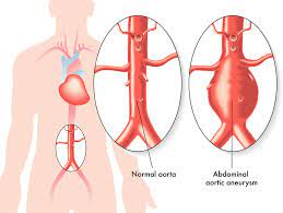 Aneurysma Formen Ursachen Symptome Diagnose Dr Stephans