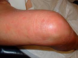 Carcinoma is a type of cancer that develops in the skin or tissues covering or lining internal organs. Merkel Cell Carcinoma An Unusual Indication For Isolated Limb Perfusion