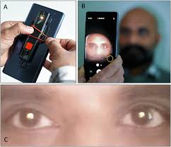 Image result for Red Reflex