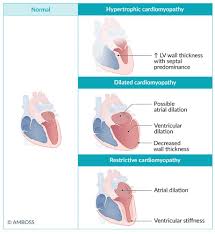 Image result for Cardiomyopathy