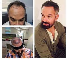 Hair Transplantation Hair Transplant Best Hair Transplant Before After Hair