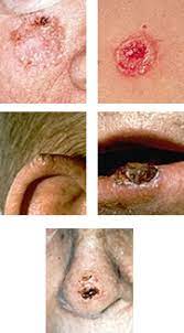 Almost all cases of small cell lung cancer are due to cigarette smoking. Types Of Cancer The Skin Cancer Center