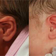 Opciones Para El Tratamiento De Orejas Con Formas Anormales En Bebes Y Ninos Healthychildren Org