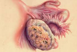 Meskipun kanker serviks tergolong mengkhawatirkan, tetapi tenang saja, pertumbuhan serviks masih bisa diantisipasi dan diobati jika diketahui lebih awal. Kanser Ovari Gejala Diagnosis Risiko