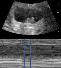Image result for First Trimester Ultrasound
