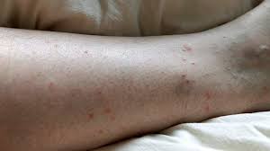 To identify a black widow spider bite, look for 2 fang marks, which will start to turn red after about an hour,. What Bit Me How To Identify Common Bug Bites Everyday Health