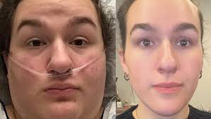 Fundraiser by Tracie Forte : Help Remove Loose Skin After Weight Loss