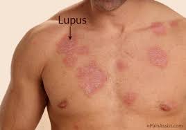 Immune cells attack the body's own healthy tissues, leading to inflammation and tissue damage. Ø§Ù„Ø¹Ø§Ù„Ù… ÙŠØ­ÙŠÙŠ ÙŠÙˆÙ… Ø§Ù„Ø°Ø¦Ø¨Ø© Ø§Ù„Ø­Ù…Ø±Ø§Ø¡ Ø§Ù„Ø¹Ø§Ù„Ù…ÙŠ ÙÙ…Ø§ Ù‡Ùˆ Ù‡Ø°Ø§ Ø§Ù„Ù…Ø±Ø¶