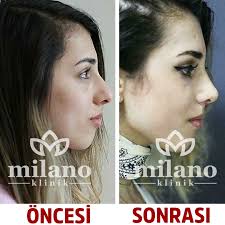 Burun Estetigi Ameliyati Ve Burun Estetigi Fiyatlari Milano Klinik Rinoplasti Yuzler Bursa