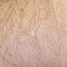 While not as common as the other causes, basal cell skin cancer can show up on the … Skin Cancer Complete Overview Of Symptoms Types