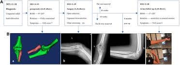 Image result for Radial Head Dislocation