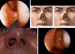 There are two main reasons for nose follicles to get infected. Rhinology Laryngology Head Neck Tumors Flashcards Quizlet
