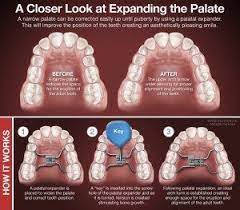 A Wider Perspective Palatal Expander Used To Save Permanent Teeth Fredericksburg Va Expanders For Teeth Palate Expander Dental Care