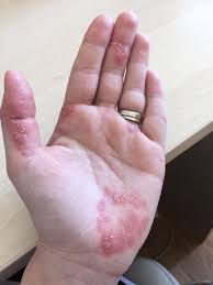 Fa un pas inainte (nu foarte mare pentru ca poate duce la suprasolicitare), coboara. Psoriazisul MÄ TerminÄ Psihic Tily Niculae