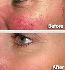 Pin On Rosacea Skin Care