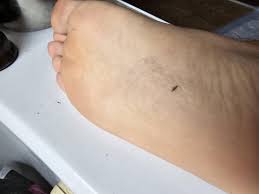 Linear mark bottom sole middle : r/Melanoma