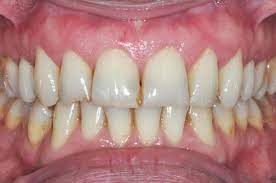 How does hydrogen peroxide work to remove stains on teeth? How Can I Prevent Staining In My Teeth