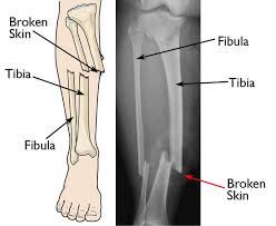Can't get my thirties worth noting: Open Fractures Orthoinfo Aaos
