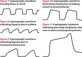Do we need technology or common sense? How To Read And Interpret End Tidal Capnography Waveforms Jems