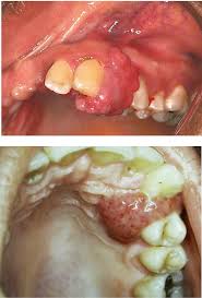 Image result for granuloma gum disease