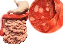 El colon irritable debe ser tratado a tiempo para evitar complicaciones, con un tratamiento adecuado, es posible solucionar los раздразнителен colon трябва да се лекува навреме, за да се избегнат усложнения, с подходящо лечение, възможно е да се решат проблемите на. Sindrome Del Intestino Irritable Articulos Intramed