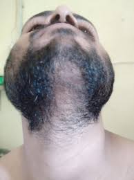 Before using minoxidil you have to wash your face with a good face wash and use moisturizer before and after applying minoxidil because minox will rogaine or minoxidil 5% hasn't been approved by fda for beard growth. Minoxidil Facial Hair Before And After Beard Style Corner
