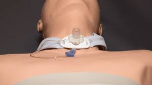 Image result for Tracheostomy